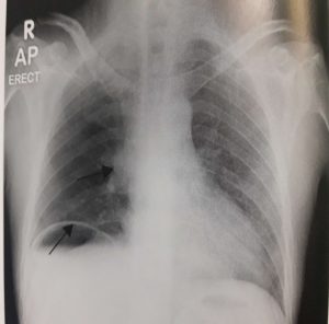 Chest X Rays 1