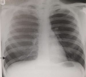 Chest X Rays 2