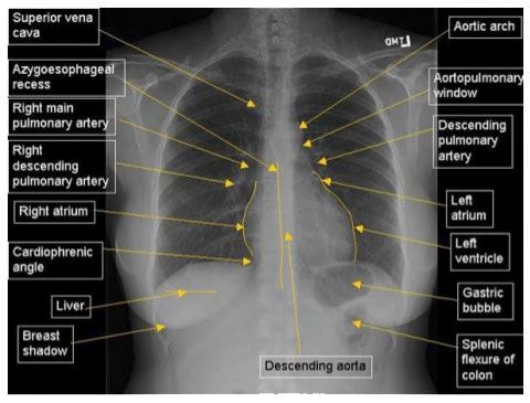 Normal Chest X Ray