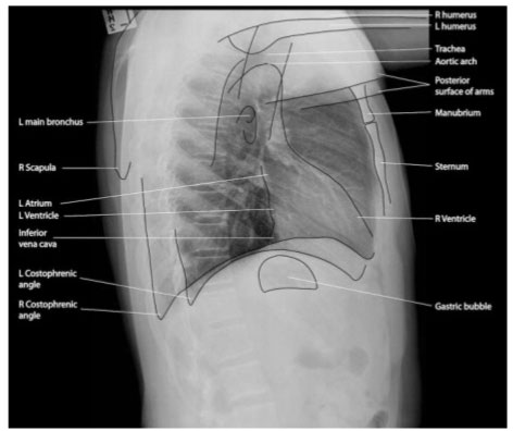 Reading Chest X Ray