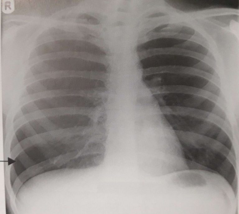 How Many Chest XRays Is It Safe To Have In A Year at Verna Casey blog
